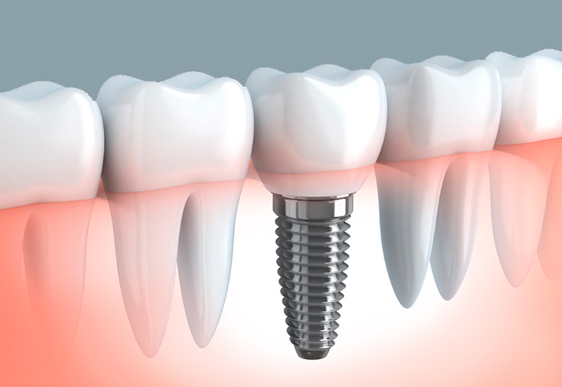 Implantología Oral